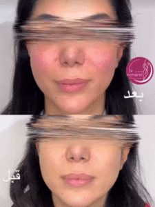 نمونه کار لیفت با نخ (دکتر محمود ارجمند)