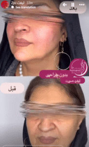 نمونه کار لیفت با نخ (دکتر محمود ارجمند)