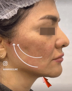 نمونه کار لیفت با نخ (دکتر رزیتا دلقندی)