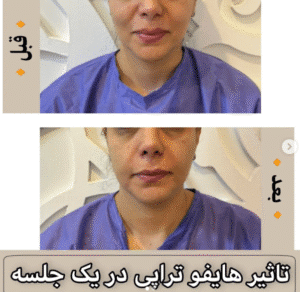 نمونه کار هایفوتراپی (کلینیک زیبایی دلوین)