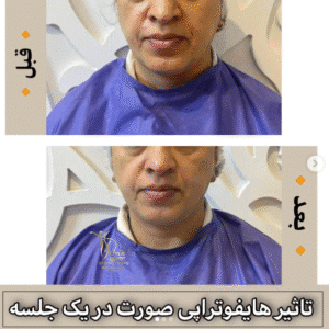 نمونه کار هایفوتراپی (کلینیک زیبایی دلوین)