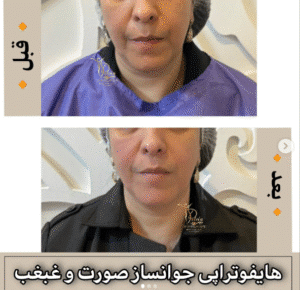 نمونه کار هایفوتراپی (کلینیک زیبایی دلوین)