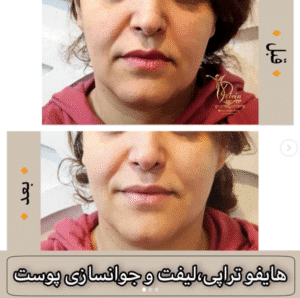 نمونه کار هایفوتراپی (کلینیک زیبایی دلوین)