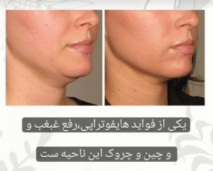 نمونه کار هایفوتراپی (کلینیک زیبایی دلوین)