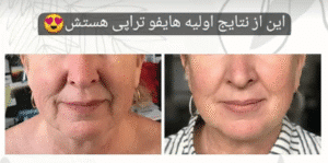 نمونه کار هایفوتراپی (کلینیک زیبایی دلوین)