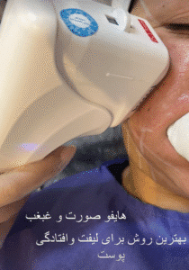 نمونه کار هایفوتراپی (کلینیک زیبایی دلوین)