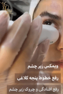 نمونه کار هایفوتراپی (کلینیک زیبایی دلوین)