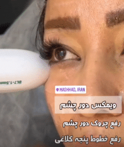 نمونه کار هایفوتراپی (کلینیک زیبایی دلوین)