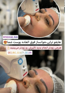 نمونه کار هایفوتراپی (کلینیک زیبایی دلوین)