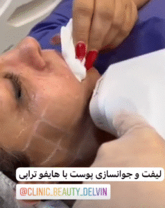 نمونه کار هایفوتراپی (کلینیک زیبایی دلوین)