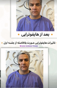 نمونه کار هایفوتراپی (کلینیک زیبایی دلوین)
