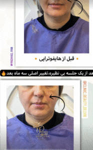 نمونه کار هایفوتراپی (کلینیک زیبایی دلوین)