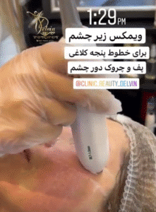 نمونه کار هایفوتراپی (کلینیک زیبایی دلوین)