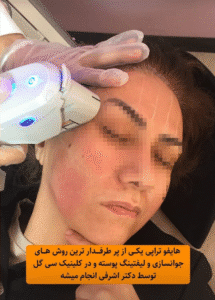 نمونه کار هایفوتراپی (کلینیک زیبایی سی گل)