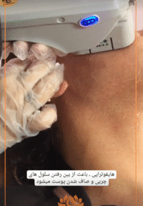 نمونه کار هایفوتراپی (کلینیک زیبایی سی گل)