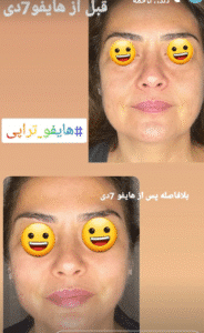 نمونه کار هایفوتراپی (دکتر الهه مولوی)