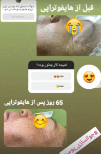 نمونه کار هایفوتراپی (دکتر الهه مولوی)