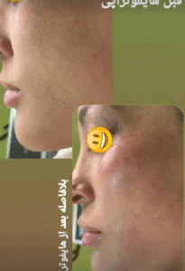 نمونه کار هایفوتراپی (دکتر الهه مولوی)