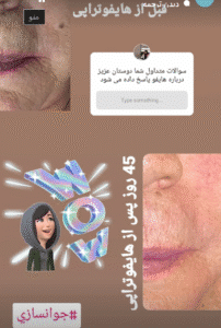 نمونه کار هایفوتراپی (دکتر الهه مولوی)