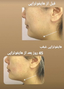 نمونه کار هایفوتراپی (دکتر الهه مولوی)