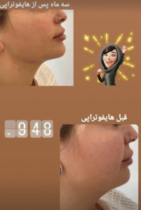 نمونه کار هایفوتراپی (دکتر الهه مولوی)