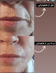 نمونه کار هایفوتراپی (دکتر الهه مولوی)