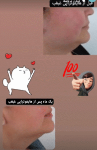 نمونه کار هایفوتراپی (دکتر الهه مولوی)