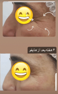 نمونه کار هایفوتراپی (دکتر الهه مولوی)