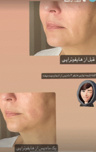 نمونه کار هایفوتراپی (دکتر الهه مولوی)