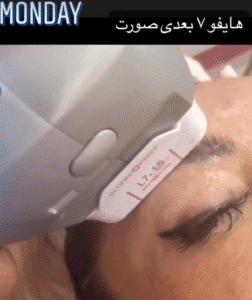 نمونه کار هایفوتراپی (دکتر الهه مولوی)