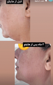 نمونه کار هایفوتراپی (دکتر الهه مولوی)