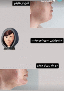 نمونه کار هایفوتراپی (دکتر الهه مولوی)