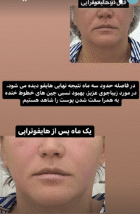 نمونه کار هایفوتراپی (دکتر الهه مولوی)