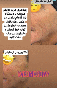 نمونه کار هایفوتراپی (دکتر الهه مولوی)