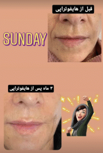 نمونه کار هایفوتراپی (دکتر الهه مولوی)