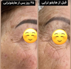 نمونه کار هایفوتراپی (دکتر الهه مولوی)