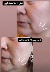 نمونه کار هایفوتراپی (دکتر الهه مولوی)