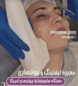 نمونه کار هایفوتراپی (کلینیک نوآوران زیبایی)