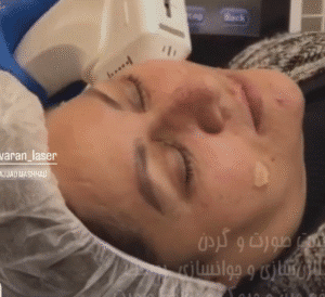 نمونه کار هایفوتراپی (کلینیک نوآوران زیبایی)