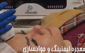 نمونه کار هایفوتراپی (کلینیک نوآوران زیبایی)