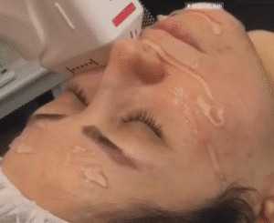 نمونه کار هایفوتراپی (کلینیک نوآوران زیبایی)