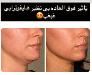 نمونه کار هایفوتراپی (دکتر سحر پارسایی)