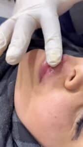 نمونه کار لیفت با نخ (دکتر سیاوش وکیلی)