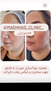 نمونه کار هایفوتراپی (کلینیک لاغری طراوت)