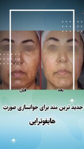 نمونه کار هایفوتراپی (کلینیک لاغری طراوت)