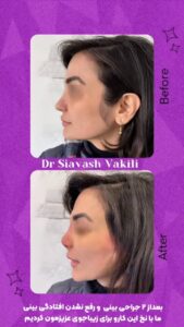 نمونه کار لیفت با نخ (دکتر سیاوش وکیلی)