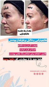 نمونه کار هایفوتراپی (کلینیک لاغری طراوت)