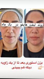 نمونه کار هایفوتراپی (کلینیک لاغری طراوت)