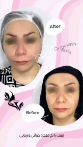نمونه کار لیفت با نخ (دکتر سیاوش وکیلی)