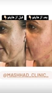نمونه کار هایفوتراپی (کلینیک لاغری طراوت)
